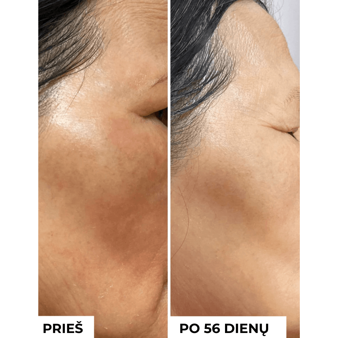 Koncentratas mažinti randelius ir pigmentaciją TXA 3% ANTI-DARK SPOTS CONCENTRATE